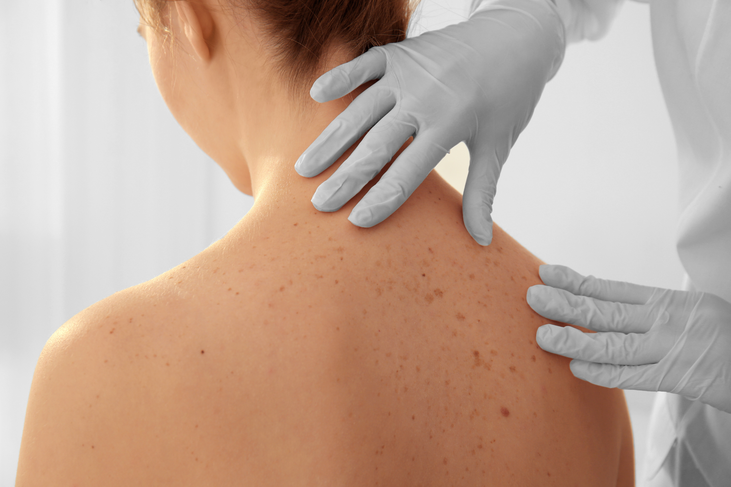 SCCA Introduction to Skin Cancer